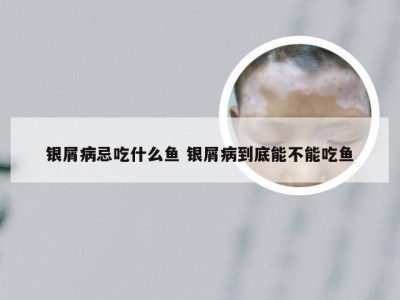 银屑病忌吃什么鱼 银屑病到底能不能吃鱼