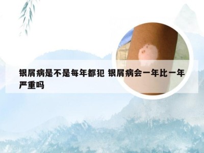 银屑病是不是每年都犯 银屑病会一年比一年严重吗
