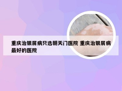 重庆治银屑病只选朝天门医院 重庆治银屑病最好的医院