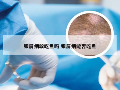 银屑病敢吃鱼吗 银屑病能否吃鱼