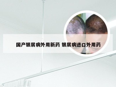 国产银屑病外用新药 银屑病进口外用药