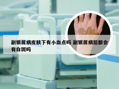 副银屑病皮肤下有小血点吗 副银屑病后都会有白斑吗