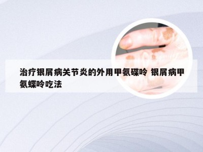 治疗银屑病关节炎的外用甲氨碟呤 银屑病甲氨蝶呤吃法