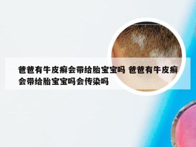 爸爸有牛皮癣会带给胎宝宝吗 爸爸有牛皮癣会带给胎宝宝吗会传染吗