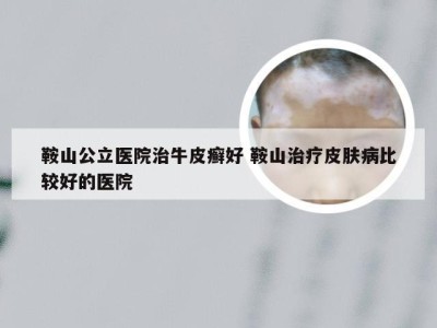 鞍山公立医院治牛皮癣好 鞍山治疗皮肤病比较好的医院