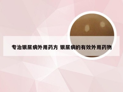 专治银屑病外用药方 银屑病的有效外用药物
