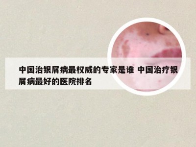 中国治银屑病最权威的专家是谁 中国治疗银屑病最好的医院排名
