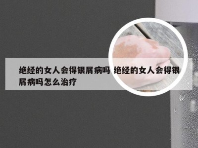 绝经的女人会得银屑病吗 绝经的女人会得银屑病吗怎么治疗