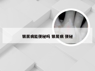 银屑病能便秘吗 银屑病 便秘