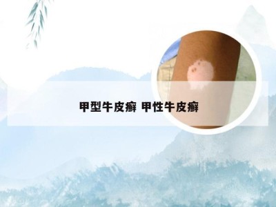 甲型牛皮癣 甲性牛皮癣