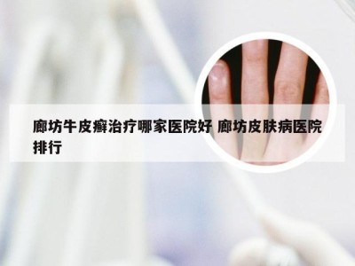 廊坊牛皮癣治疗哪家医院好 廊坊皮肤病医院排行