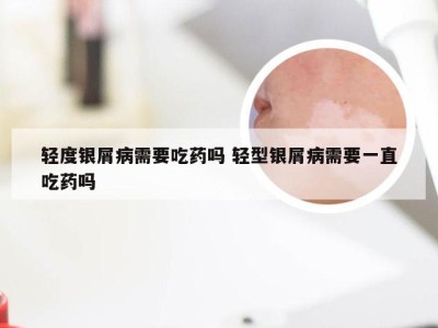 轻度银屑病需要吃药吗 轻型银屑病需要一直吃药吗