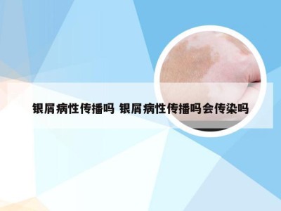 银屑病性传播吗 银屑病性传播吗会传染吗