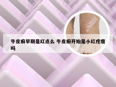 牛皮癣早期是红点么 牛皮癣开始是小红疙瘩吗