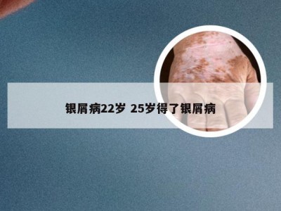 银屑病22岁 25岁得了银屑病