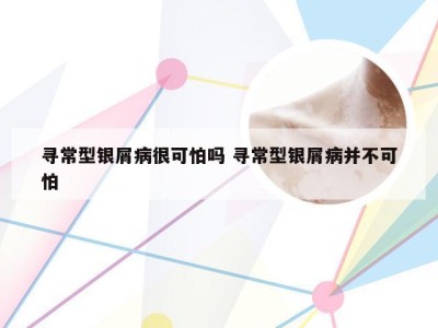 寻常型银屑病很可怕吗 寻常型银屑病并不可怕