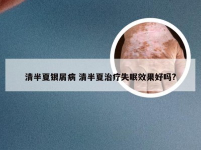 清半夏银屑病 清半夏治疗失眠效果好吗?