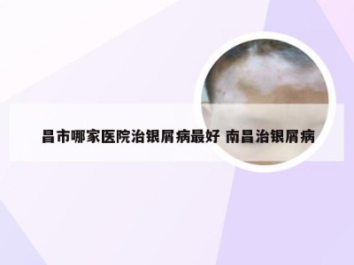 昌市哪家医院治银屑病最好 南昌治银屑病