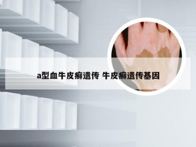 a型血牛皮癣遗传 牛皮癣遗传基因