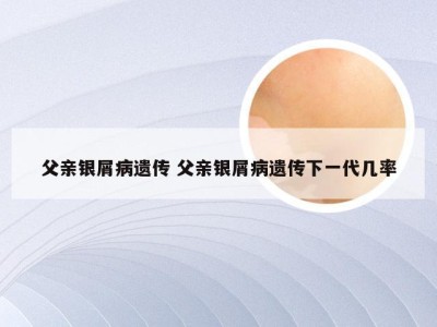 父亲银屑病遗传 父亲银屑病遗传下一代几率