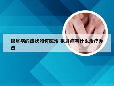 银屑病的症状如何医治 银屑病有什么治疗办法
