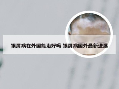 银屑病在外国能治好吗 银屑病国外最新进展