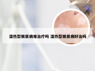 湿热型银屑病难治疗吗 湿热型银屑病好治吗