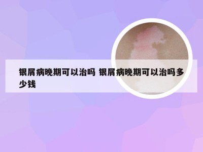 银屑病晚期可以治吗 银屑病晚期可以治吗多少钱