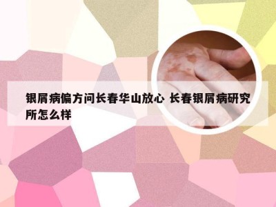 银屑病偏方问长春华山放心 长春银屑病研究所怎么样