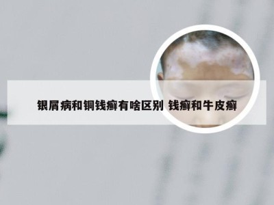 银屑病和铜钱癣有啥区别 钱癣和牛皮癣