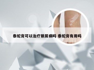 泰蛇膏可以治疗银屑病吗 泰蛇膏有用吗
