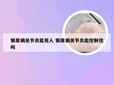 银屑病关节炎能死人 银屑病关节炎能控制住吗