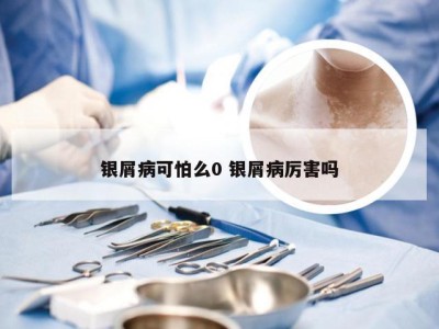 银屑病可怕么0 银屑病厉害吗