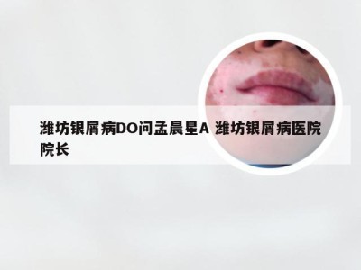 潍坊银屑病DO问孟晨星A 潍坊银屑病医院院长