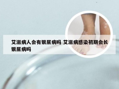 艾滋病人会有银屑病吗 艾滋病感染初期会长银屑病吗