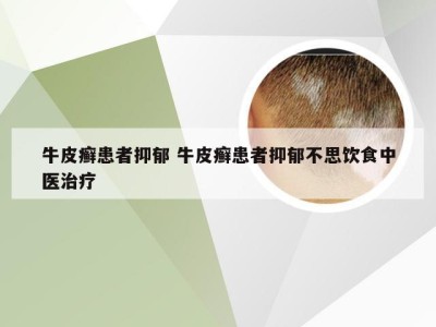 牛皮癣患者抑郁 牛皮癣患者抑郁不思饮食中医治疗