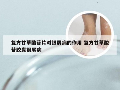 复方甘草酸苷片对银屑病的作用 复方甘草酸苷胶囊银屑病