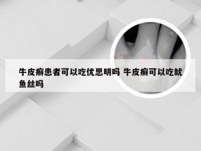 牛皮癣患者可以吃优思明吗 牛皮癣可以吃鱿鱼丝吗
