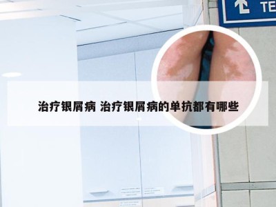 治疗银屑病 治疗银屑病的单抗都有哪些