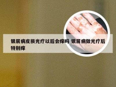 银屑病皮损光疗以后会痒吗 银屑病做光疗后特别痒