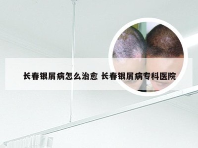 长春银屑病怎么治愈 长春银屑病专科医院