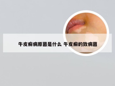 牛皮癣病原菌是什么 牛皮癣的致病菌