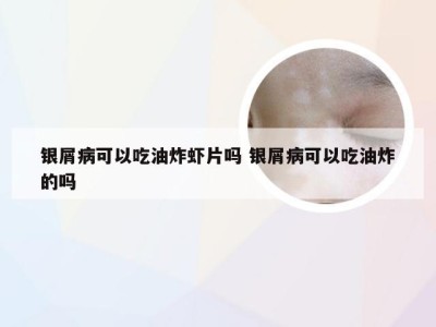 银屑病可以吃油炸虾片吗 银屑病可以吃油炸的吗