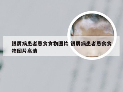 银屑病患者忌食食物图片 银屑病患者忌食食物图片高清