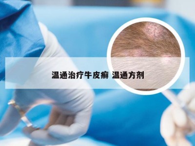 温通治疗牛皮癣 温通方剂