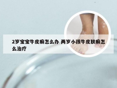 2岁宝宝牛皮癣怎么办 两岁小孩牛皮肤癣怎么治疗