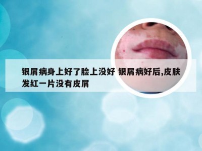 银屑病身上好了脸上没好 银屑病好后,皮肤发红一片没有皮屑