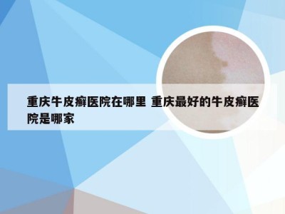 重庆牛皮癣医院在哪里 重庆最好的牛皮癣医院是哪家