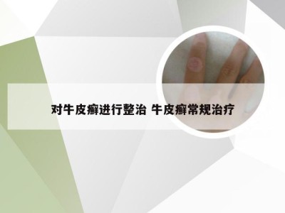 对牛皮癣进行整治 牛皮癣常规治疗
