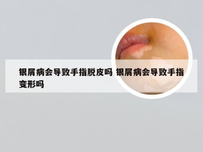银屑病会导致手指脱皮吗 银屑病会导致手指变形吗